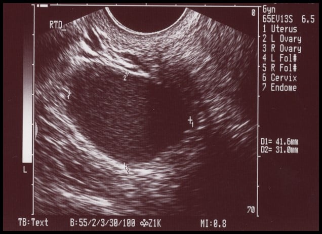 Corpus Luteum Ultrasound